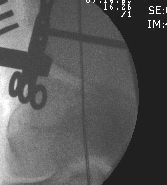 Distal Femoral Osteotomy Puddhu Plate